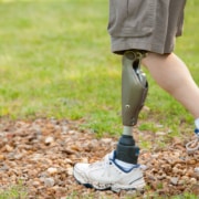 Prothesenversorgung bei Carepoint – Hautpflege unter Prothesen