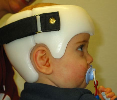 Helmtherapie Carepoint Sanitatshaus Orthopadietechnik