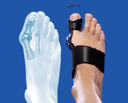 hallux valgus endlich schmerzfrei